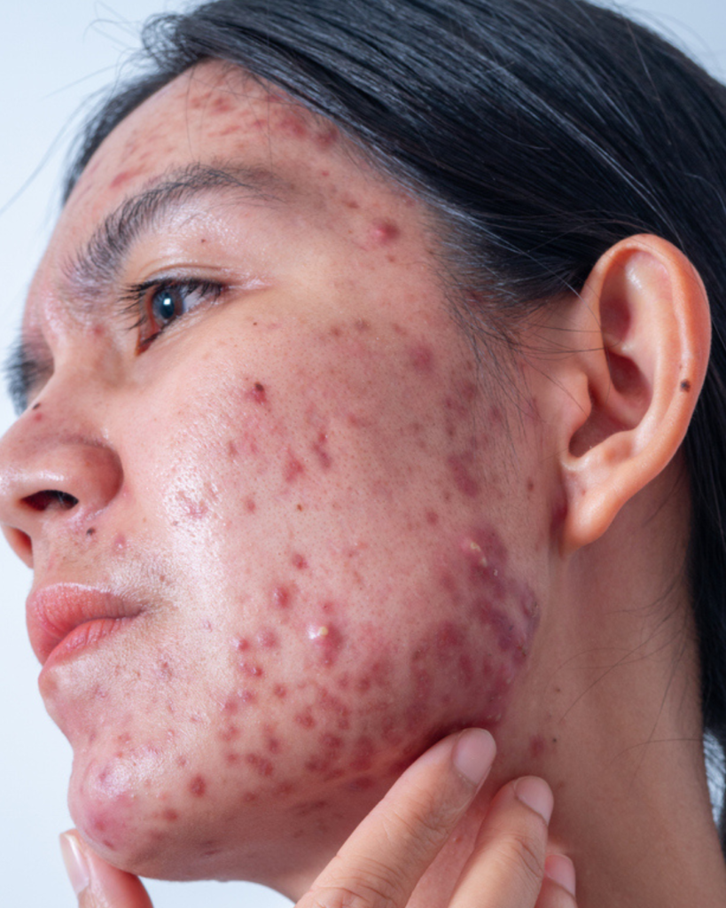 Acne_Vulgaris
