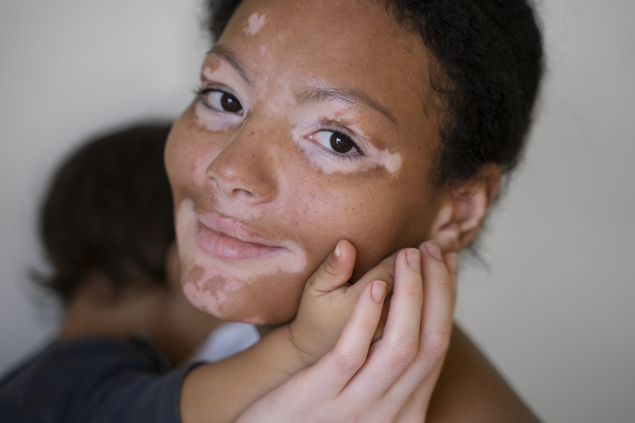 vitiligo